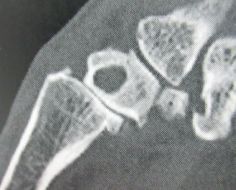 Prise en charge de la Rhizarthrose