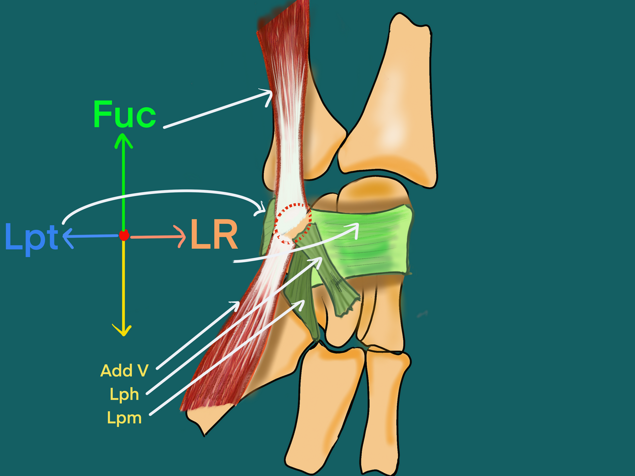 Arthrose piso-triquetrale : une alternative chirurgicale à la  pisiformectomie - Résultats préliminaires