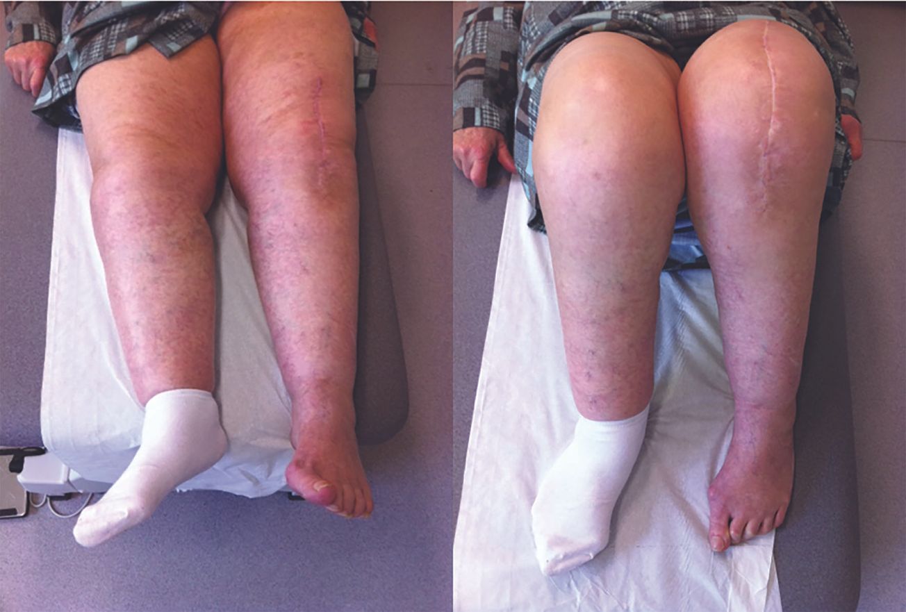 Quel bilan en cas d’instabilité fémoro-patellaire après prothèse totale de genou ?