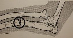 Fractures de Montegglia à déplacement postérieur opérées