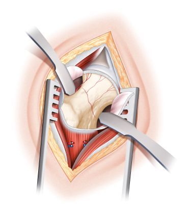 L’ostéotomie fémorale a-t-elle encore une place  dans la chirurgie conservatrice de la hanche ?