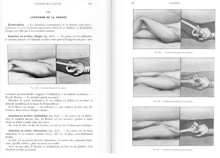 Luxations de la hanche