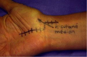 Ténosynovites du poignet : traitement chirurgical