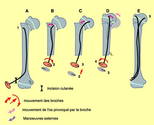 Technique de l'embrochage (ECMES) des fractures du membre supérieur chez l'enfant