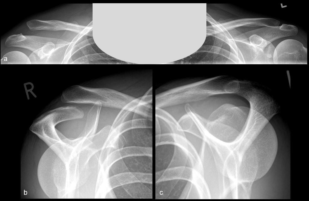 Innovations dans la reconstruction de l’articulation acromioclaviculaire  au moyen d’implants à profil bas