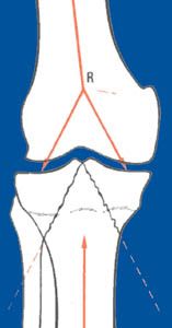 Les fractures récentes des plateaux tibiaux de l'adulte : physiopathologie, diagnostic, classification et traitement