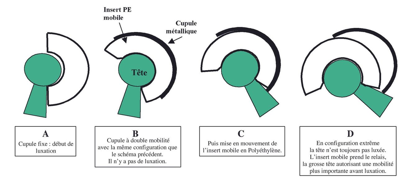 La troisième articulation des prothèses de hanche à double mobilité