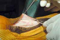 Chirurgie des tendinopathies d'Achille du sportif