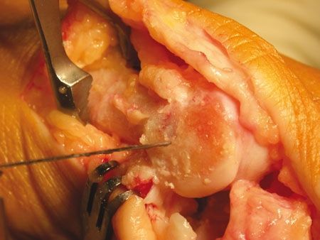 Le chevron (Ostéotomie épiphyso-métaphysaire distale en V du premier métatarsien)