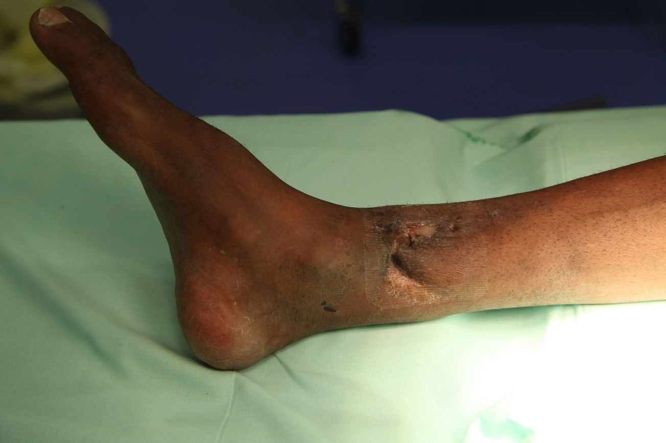 La traumatologie à l’hôpital du bagne