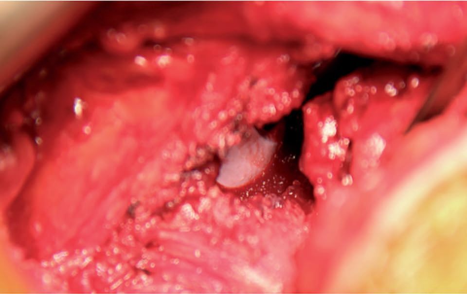 Voie postéro externe mini invasive de hanche : Anatomie Chirurgicale et ses Variations