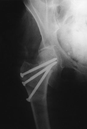 Fractures de l'extrémité supérieure du fémur en coxa valga et tamponnade : mythe ou réalité ?