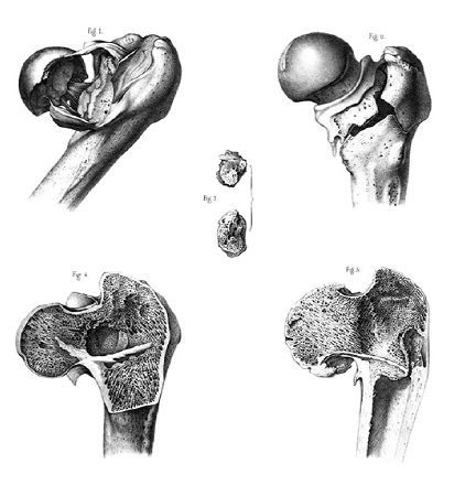 Extrait de l'Atlas du Traité des Fractures et des luxations - Planche XII : Fractures intra et extra-capsulaires du col du fémur