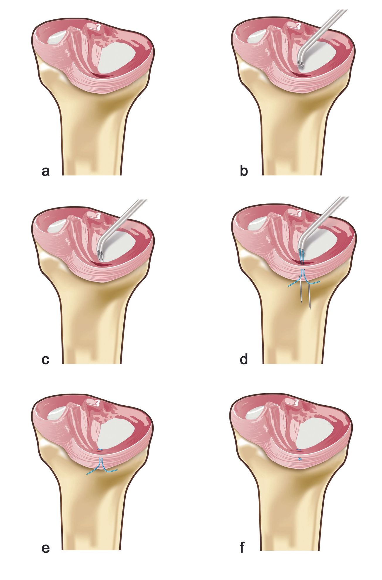 Prise en charge des lésions méniscales