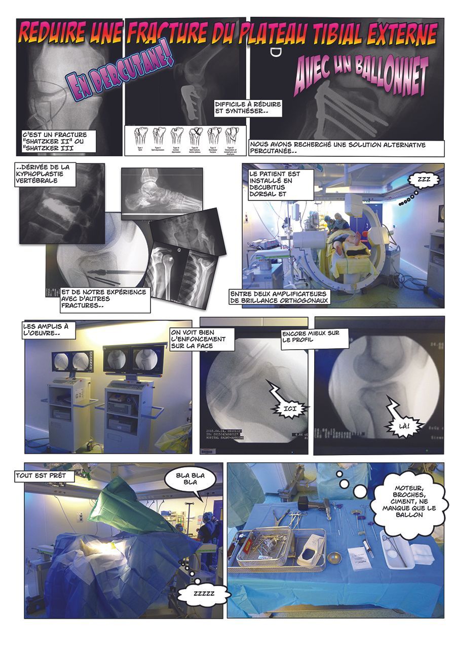 Comment réduire une fracture du plateau tibial externe avec un ballonnet, en percutané