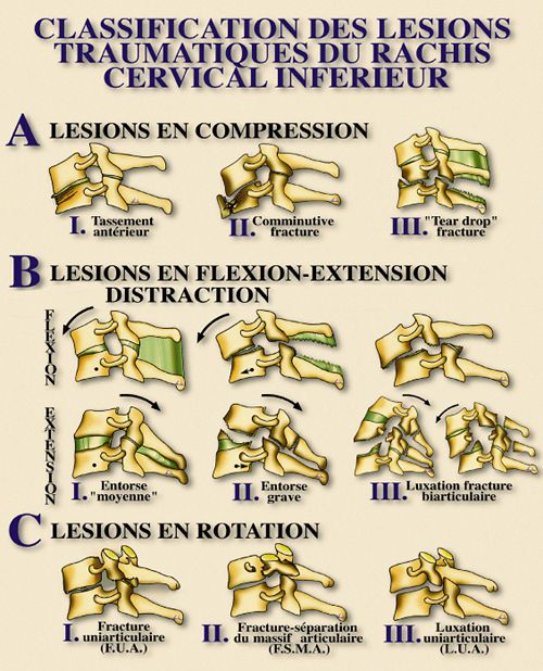 Classification des lésions traumatiques du rachis cervical inférieur