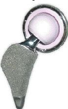 Un nouveau concept de prothèses conservatives : la Proxima