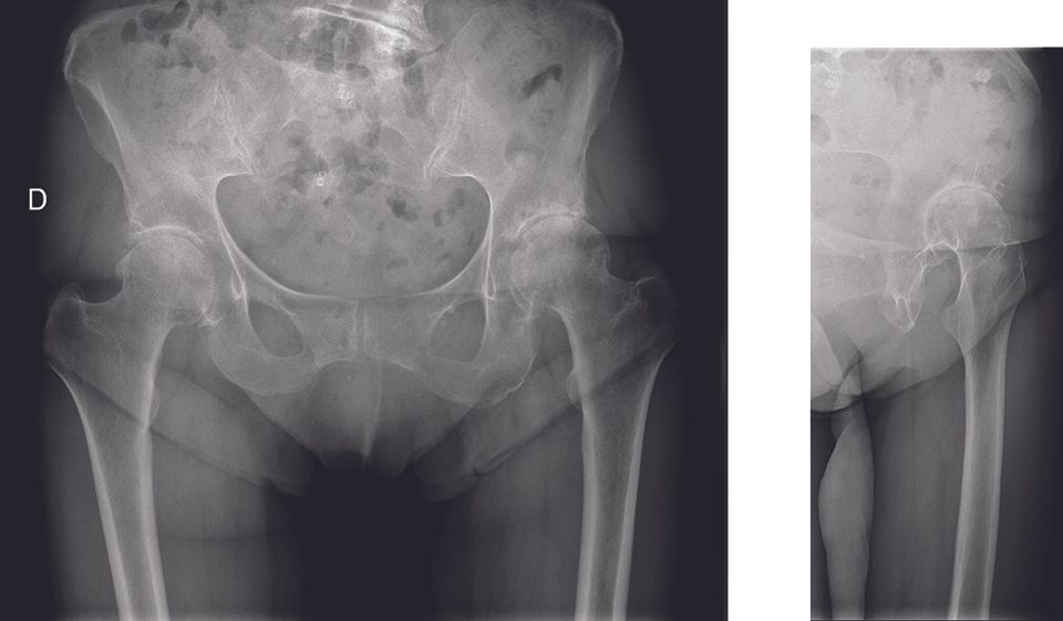 Planification d’une Prothèse Totale de Hanche