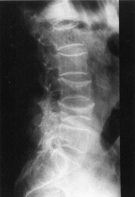 Diagnostic radiologique d'un tassement vertébral non traumatique récent.