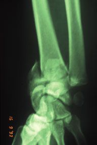 Ostéotomie précoce des cals vicieux articulaires de l'extrémité distale du radius