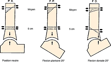 Prothèse de cheville Ramses : concept- technique opératoire-résultats . A propos des 38 premiers cas