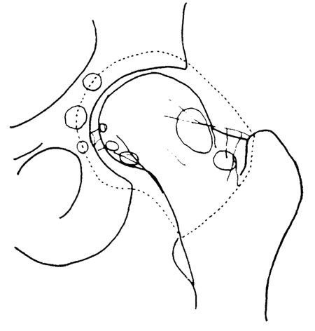 La synovite villonodulaire de hanche