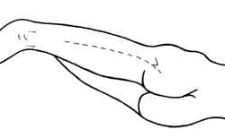 L'abord transfémoral dans les reprises de prothèse totale de hanche