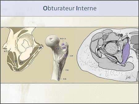 Lésions traumatiques des muscles profonds de la hanche en IRM