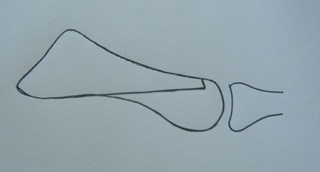 Traitement chirurgical de l'hallux valgus par mini-abord