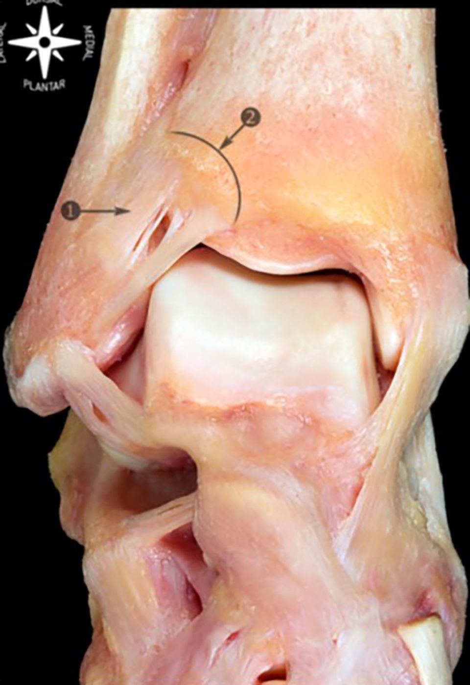 Un algorithme de diagnostic des lésions syndesmotiques graves ou  « entorses de la cheville haute » : antécédents médicaux, examens physiques et imagerie