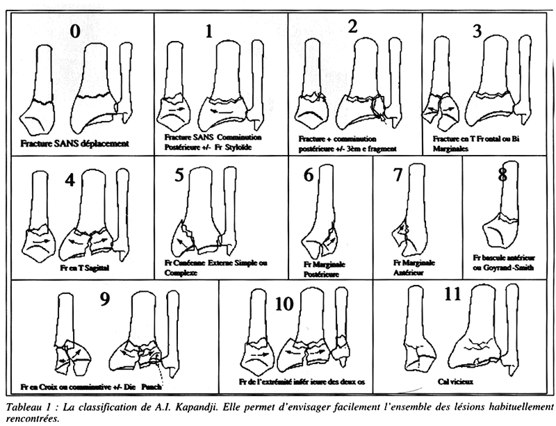 Comment nous traitons les fractures de l'extremité inférieure du radius