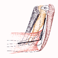 Comment je fais une arthrolyse du coude