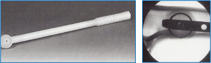 Verrouillage distal des clous centromédullaires,  évolution, état de l’art.