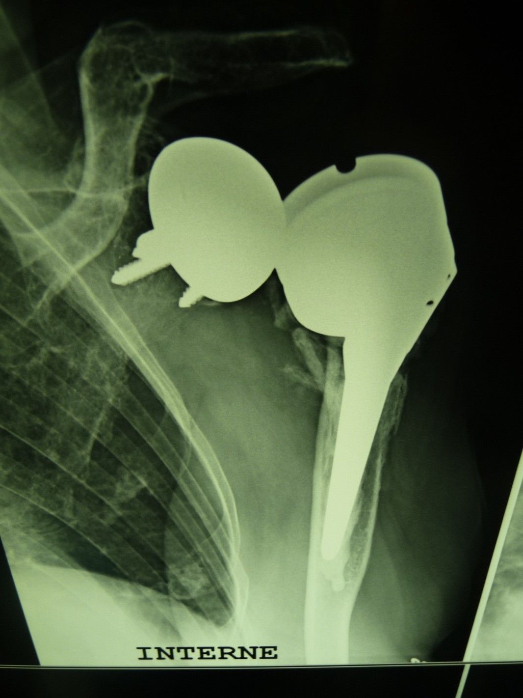 Comment prendre en charge une arthroplastie totale inversée instable de l’épaule ? :  Étude rétrospective de 25 cas