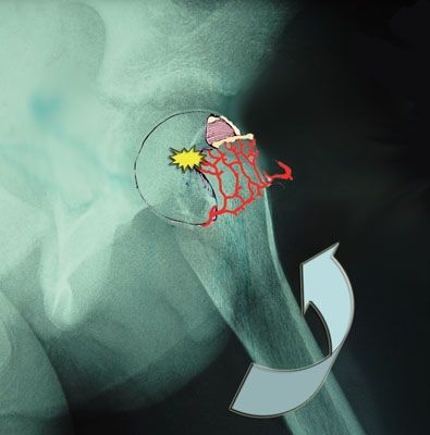 Traitement des épiphysiolyses fémorales supérieures instables - la technique de réduction progressive par traction