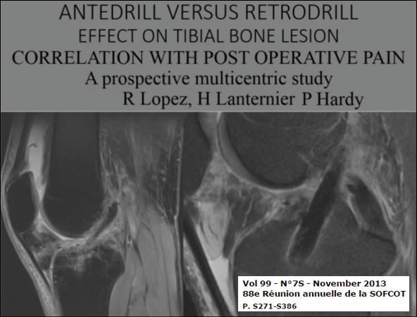 La greffe courte de ligament croisé antérieur : anatomie d'un concept disruptif