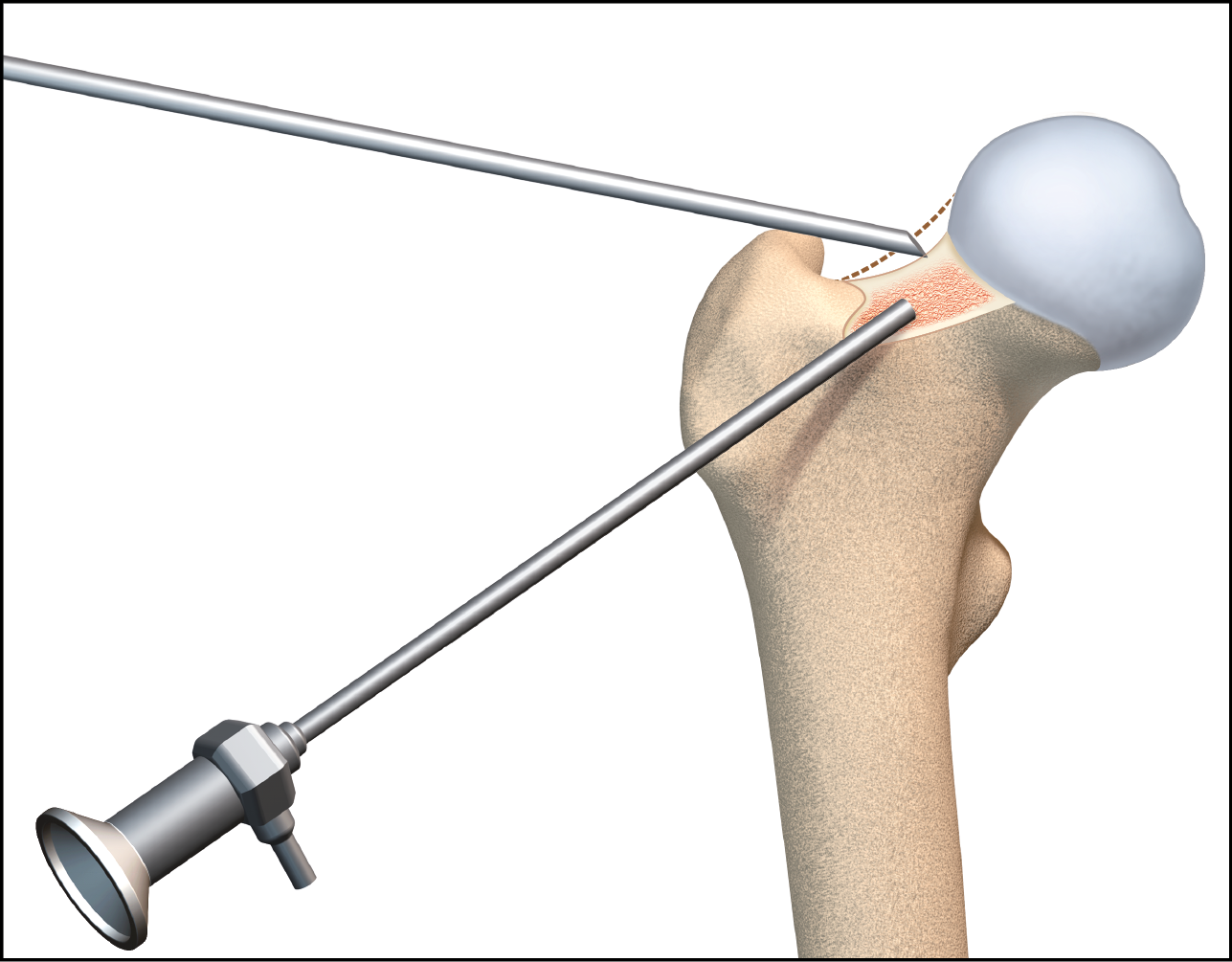 Arthroscopie de hanche chez le sportif