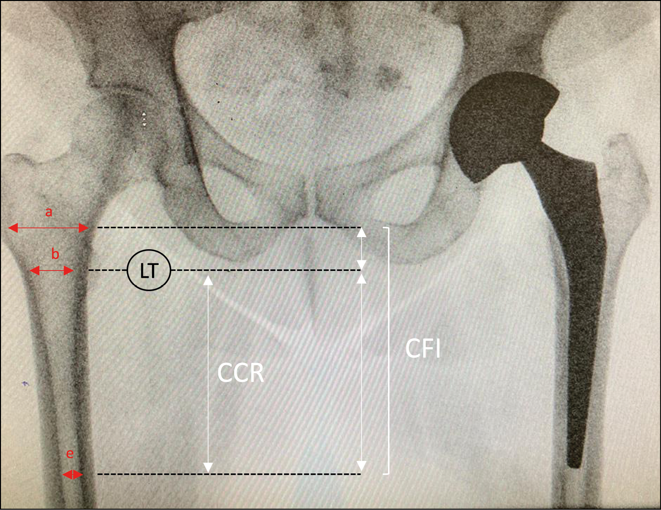 La voie d’abord chirurgicale influence-t-elle l’encombrement prothétique endo-médullaire de la pièce fémorale lors de la pose d’une PTH ?