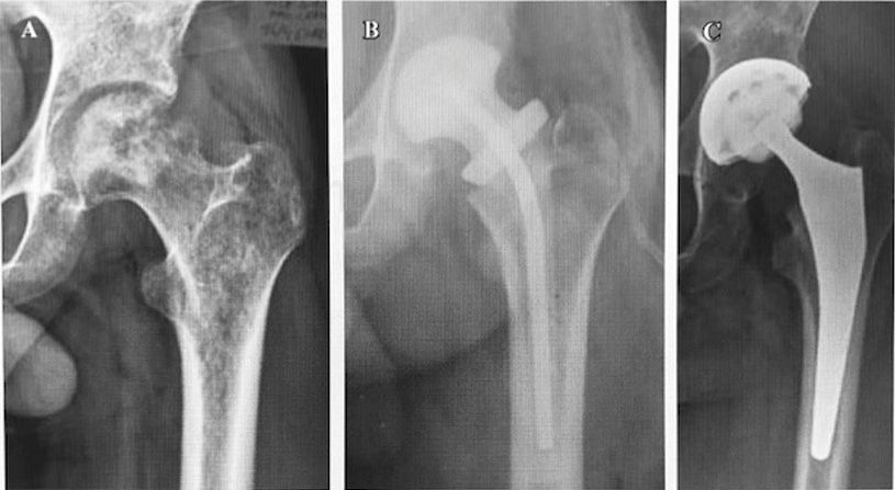 Arthroplastie pour séquelles après une arthrite septique de la hanche : directives thérapeutiques relatives à une procédure en un ou deux temps