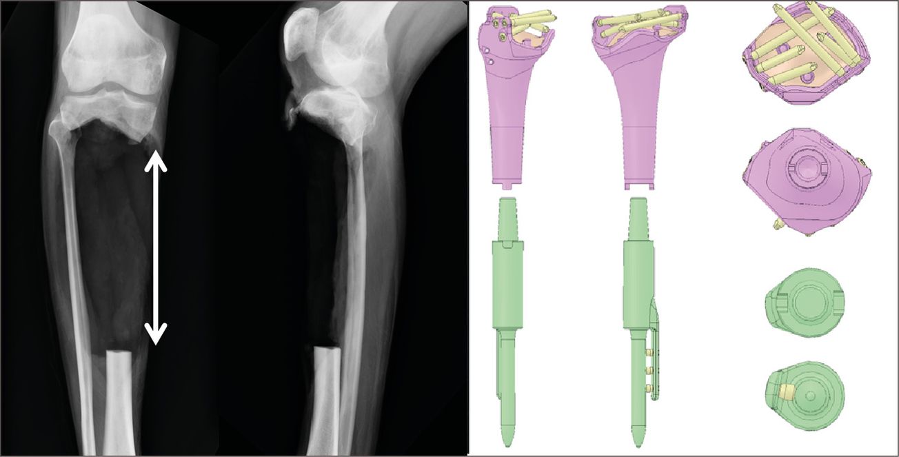 Revêtements antibactériens pour les implants : informations importantes pour les chirurgiens