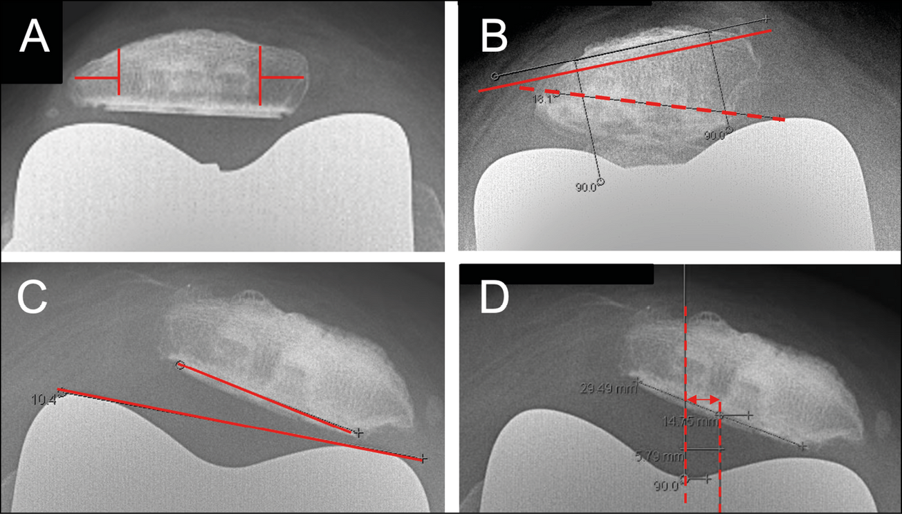 Prothèses totales de genou et patella