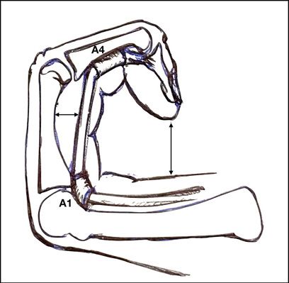 Rupture des poulies des tendons fléchisseurs concept actuel