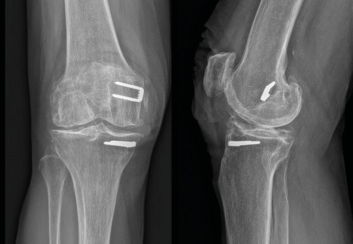 Prothèse totale de genou avec matériel en place