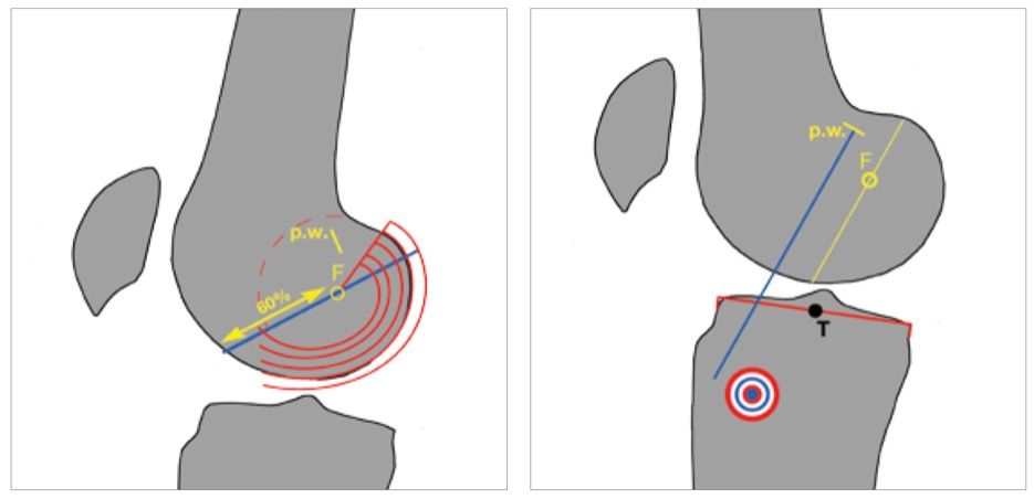 Reconstruction du ligament croisé antérieur avec LARS : expérience monocentrique de 2010 à 2017