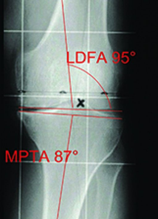 Siegfried Hofmann - Genu Varum
