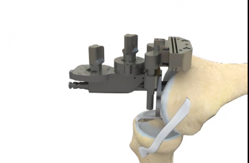 Luc Kerboull - Prothèse totale de genou