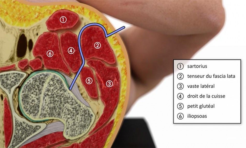 Voie antérieure sans extension de table et double mobilité.