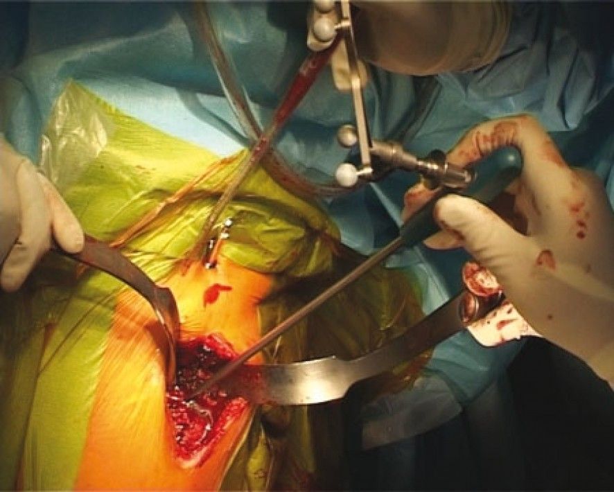 Navigation and the square angle pointer in hip resurfacing: a preliminary report