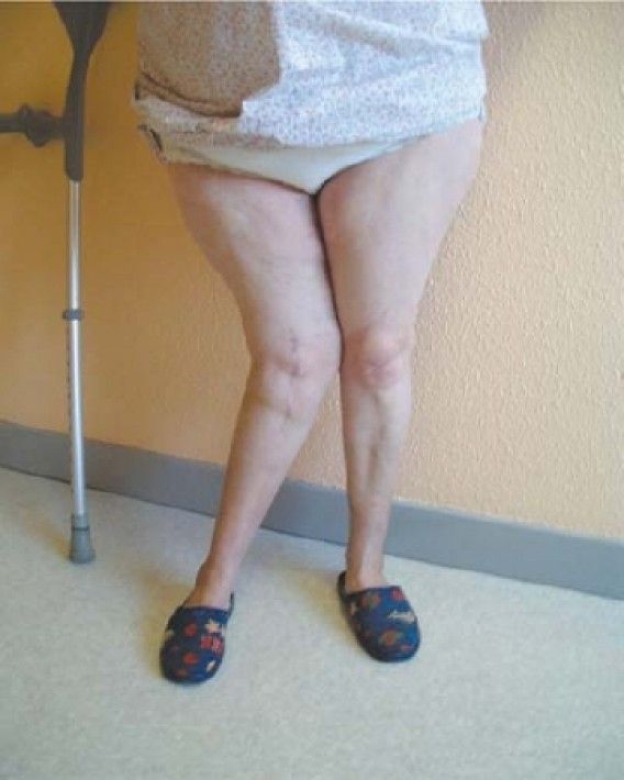 Gérard Deschamps - Lateral femorotibial arthritis (LFTA) associated with genu valgum: ethiopathogeny and surgical consequences