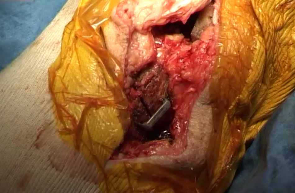 Yves Catonné - Prothèse totale de genou associée à une ostéotomie fémorale ou tibiale